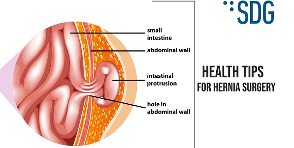 Health tips for Hernia surgery